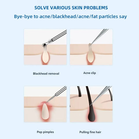 Acne extractor and blackhead remover -7